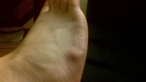 Is This A Cyst On My Foot How Do I Treat It Cherrywood Foot Care