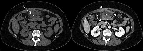 Axial Pre And Postcontrast Ct Of The Upper Abdomen Revealing A
