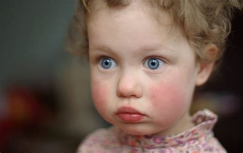 Slapped Cheek Syndrome This Childhood Condition Causes Red Cheeks