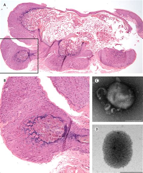 Molluscum Contagiosum Virus Infection The Lancet Infectious Diseases