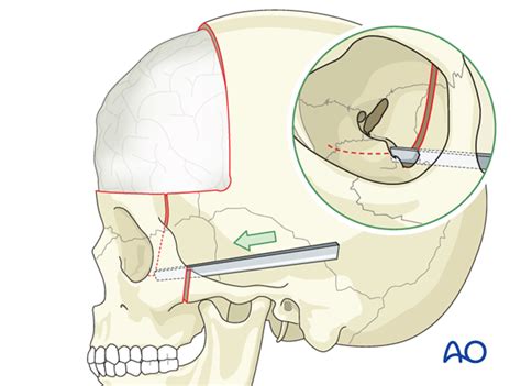 Four Wall Box Osteotomy Of The Orbits For Intraorbital Hypertelorism