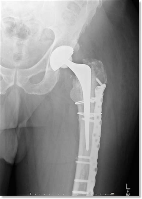 Core Othopaedic Knowledge Periprosthetic Hip Fractures St3