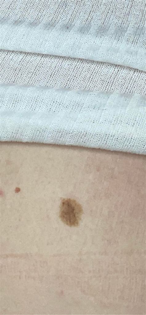 Is This Melanoma Ive Had This Since A Child Amber Never Paid Much