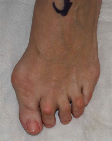 Toe Deformities The Tagoe Clinic
