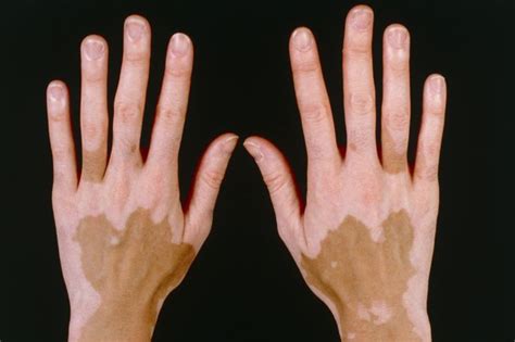 Hi doctor.i have chronic itching of skin. Vitiligo - NHS.UK