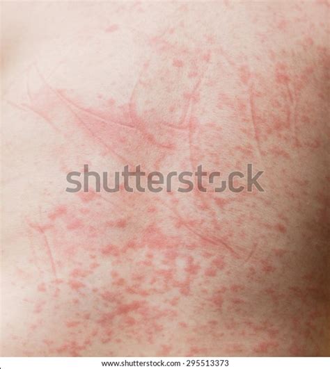 Red Spots On Babys Skin Due Stock Photo 295513373 Shutterstock