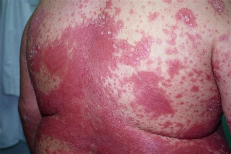 Plaque Psoriasis Symptoms Dorothee Padraig South West Skin Health Care