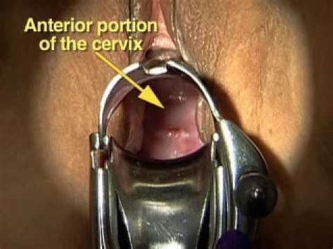 Speculum Exam2 YouTube