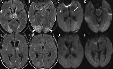 Posterior Reversible Encephalopathy Syndrome With Thalamic Involvement During Vasopressor