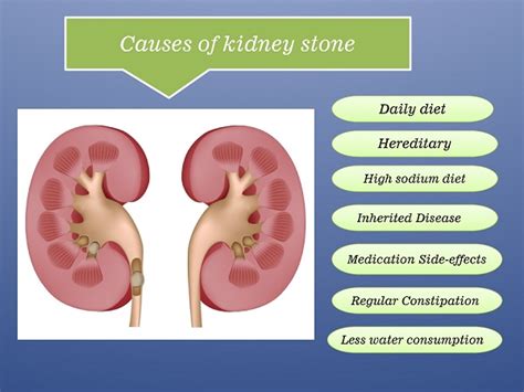 Several factors cause gallstone formation. Herbal Medicine For Kidney Stone | Natural Remedies To ...