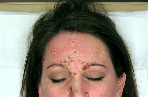 ‘crater Face Woman Whos Never Felt Beautiful Has Fleshy Lumps Cut Off Her Face By Dr Pimple