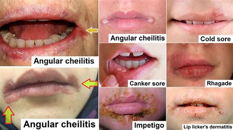 Angular Cheilitis Or Cold Sore