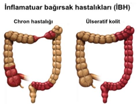 Crohn hastalığı olan hastalar, bağırsak ülseri, yorgunluk, iltihaplanma, rahatsızlık ve ağrı gibi çeşitli rahatsız edici semptomlar yaşarlar. İnflamatuar bağırsak hastalıkları nedir ve nasıl oluşur ...