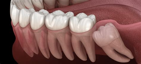 Wisdom Tooth Removal After Care Evergreen Dental Care