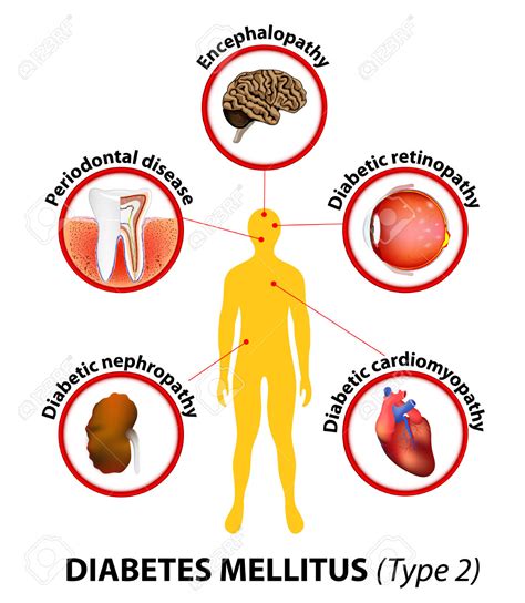 Type 2 diabetes is caused by either inadequate production of the hormone insulin or a lack of response to insulin by various cells of the body. Diabetes Mellitus Type 2 Affected Organs Untreated ...