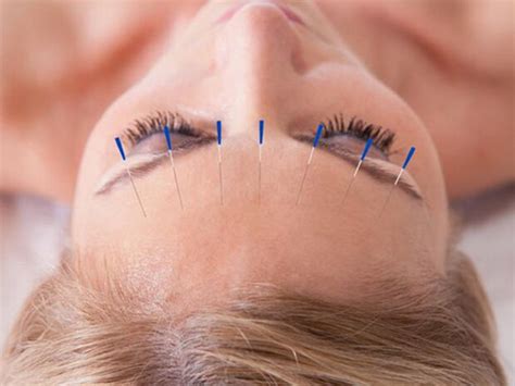 Benarkah Akupunktur Muka Dapat Membuat Kulit Muka Kelihatan Lebih Muda