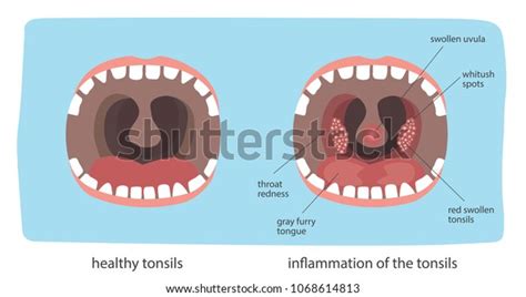 Poster Infographics Illustration Healthy Throat Difference Stock Vector