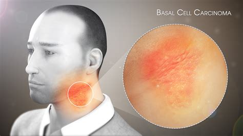 Dermatita Seboreica Cauze Simptome I Cum Se Trateaz Acas Suflet Hot