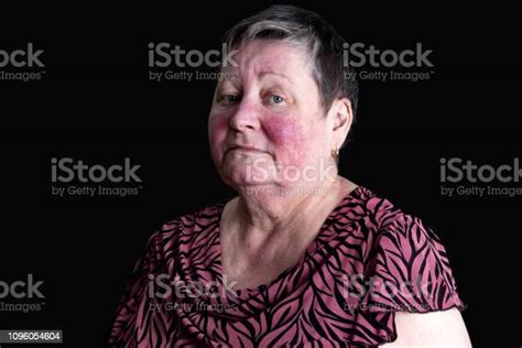 Portrait Of Very Sad Elderly Woman Suffering Skin Disease Rosacea With