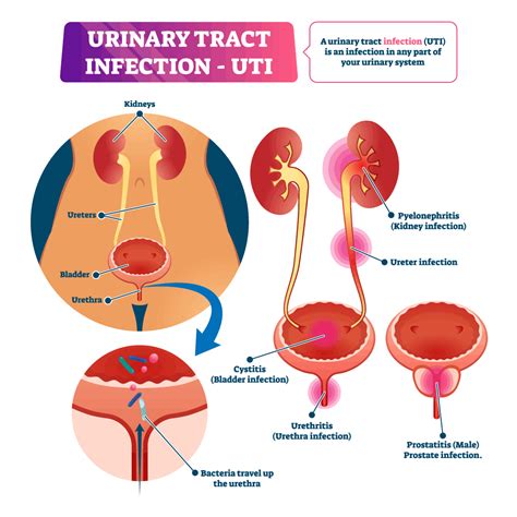 Urinary Tract Infection Symptoms Uti Online Prescription Fast Uti Cloudwell Health