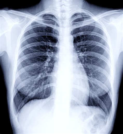 How Does Normal Lung X Ray Look Preventive Healthcare