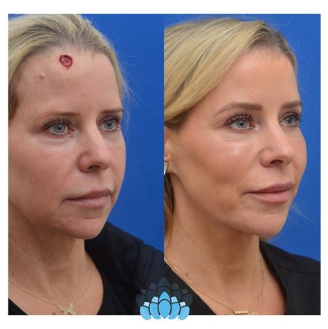 Mohs Skin Cancer Surgery Before And After Photo Gallery Charlotte NC Dilworth Facial