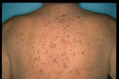 20112 11eponyms C Our Dermatology Online