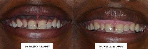 Dark Gum Depigmentation Before And After Photos Dr William Lamas