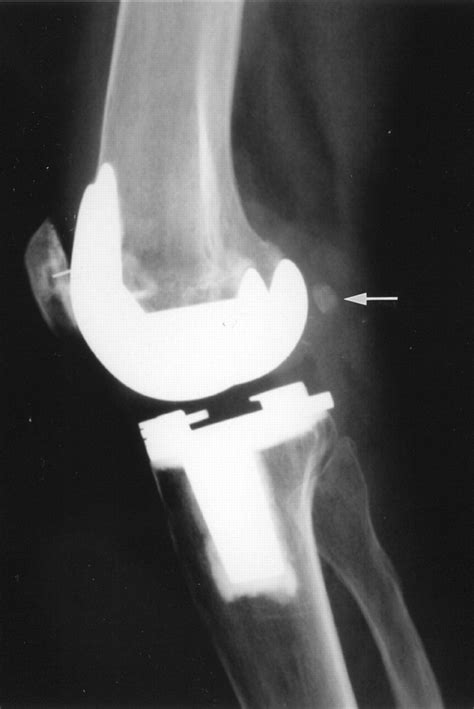 Fabellar Snapping As A Cause Of Knee Pain After Total Knee Replacement