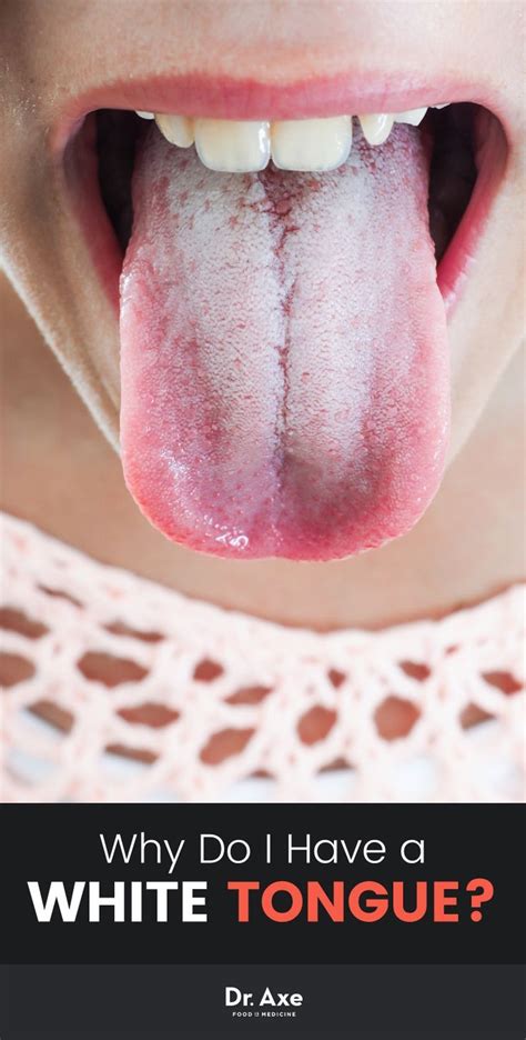 There Are Simple Natural Remedies That Get Rid Of White Tongue Get Rid Of Bad Breath And Boost