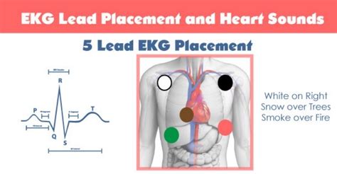 5 Lead Ecg Placement Diagram