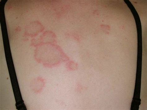 Cutaneous Lupus Erythematosus Pictures 3 Subacute Cutaneous Lupus