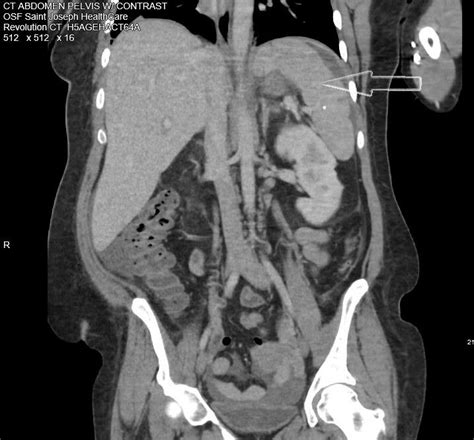 Computed Tomographic Ct Abdominal Scan With Contrast Showing One Of