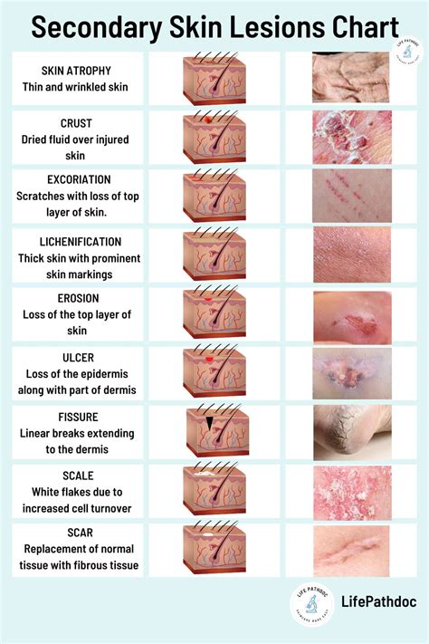 Skin Lesions Chart