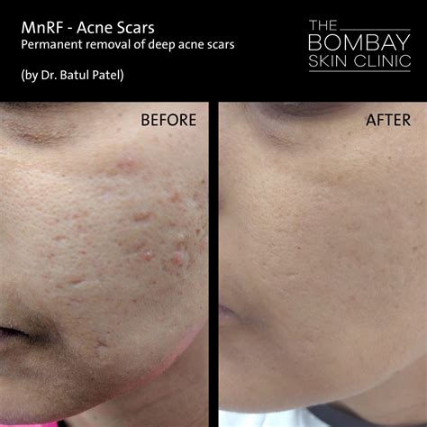 Treatments Before After The Bombay Skin Clinic