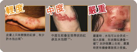 《养蛇生蛋》,土豆芽儿,生子 情有独钟 穿越时空 种田文,主角：舒锦天，舒寒钰 ┃ 配角：严泽，林益，红枣，果果 ┃ 其它：一窝多生|最 晋江app→右上角人头→右上角小框. 生蛇疫苗,生蛇疫苗費用-MEDISHINE 香港悅仁醫療