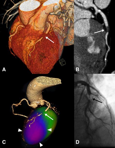 Coronary Artery Computed Tomography Scanning Circulation