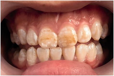 Minimally Invasive Esthetic Management Of Dental Fluorosis A Case