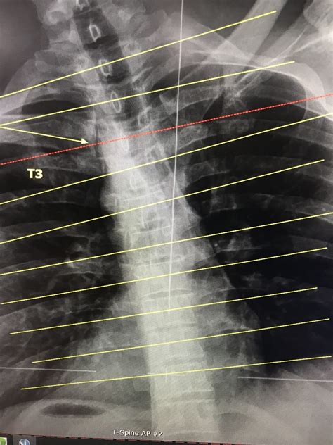 Thoracic Lateral Bending D X Ray Demonstrating T3 Subluxation And