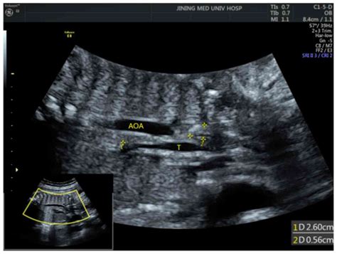 Tracheoesophageal Fistula Ultrasound