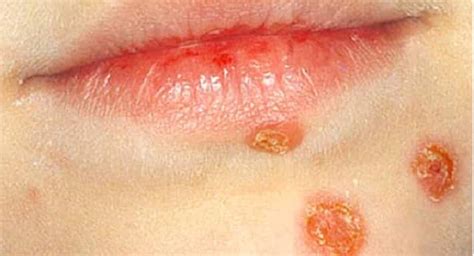Impetigo Beware Of The Common Summer Skin Infection Among Kids
