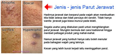 Namun ada juga beberapa jenis pil kombinasi lain yang tidak tersenarai di sini yang mungkin berkesan untuk hilangkan jerawat anda. Cara Menghilangkan Jeragat: Cara Hilangkan Parut Jerawat