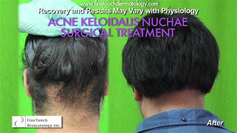 Download Acne Keloidalis Nuchae Bumps On Back Of Head After Haircut Png
