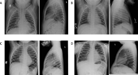 Chest Radiograph Interpretation Journal Of Hospital Medicine