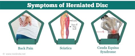 Herniated Disc Causes Symptoms Diagnosis Treatment Complications