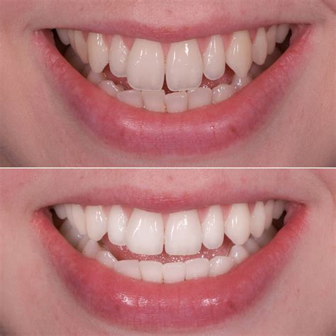 Tooth Contouring How Cosmetic Teeth Reshaping Works And The After