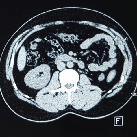 A B Urethrocystoscopy Showing A Large Intraluminal Protruding Mass