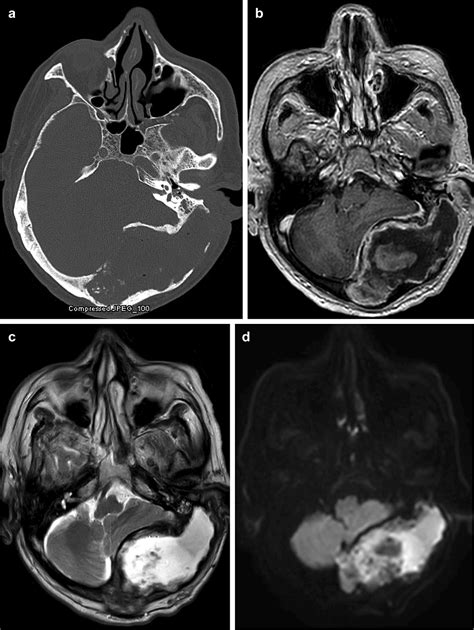 Cureus Rare Giant Infected Intradiploic Skull Epidermoid Cysts