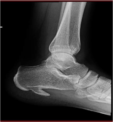 Lateral Radiograph Of The Left Ankle Joint Showing A Massive