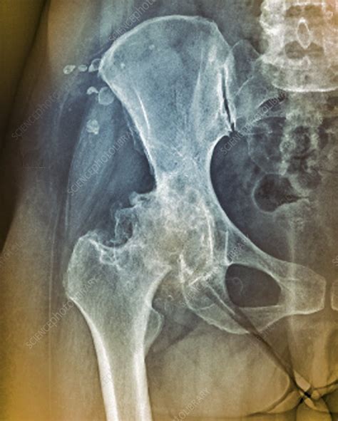 Osteoarthritis Of The Hip X Ray Stock Image C0403325 Science